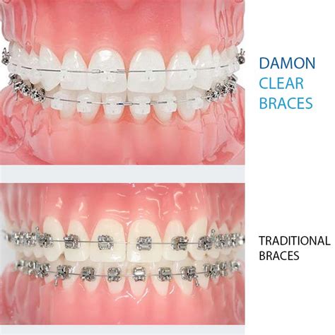 damon metal brackets|damon clear braces pictures.